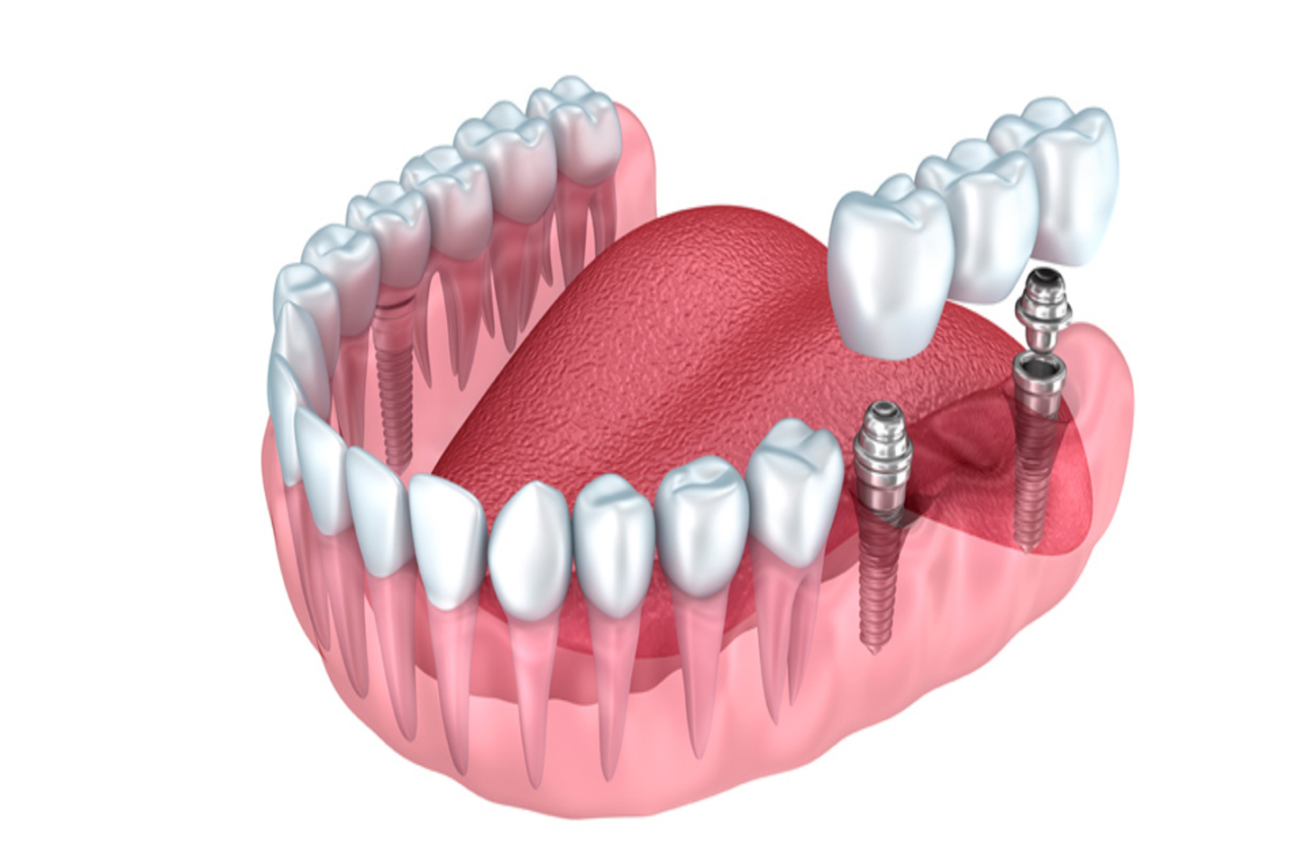 Colocación de Coronas y Puentes